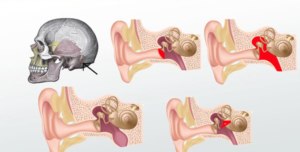 Middle Ear Disorder